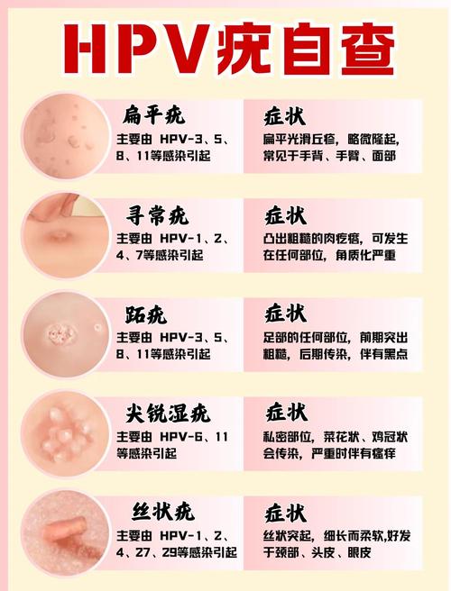 hp一定会传染吗