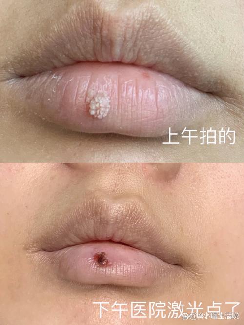 感染hpv后会出现哪些症状?嘴唇上出现3个症状,或许hpv早已找上你!_百度...