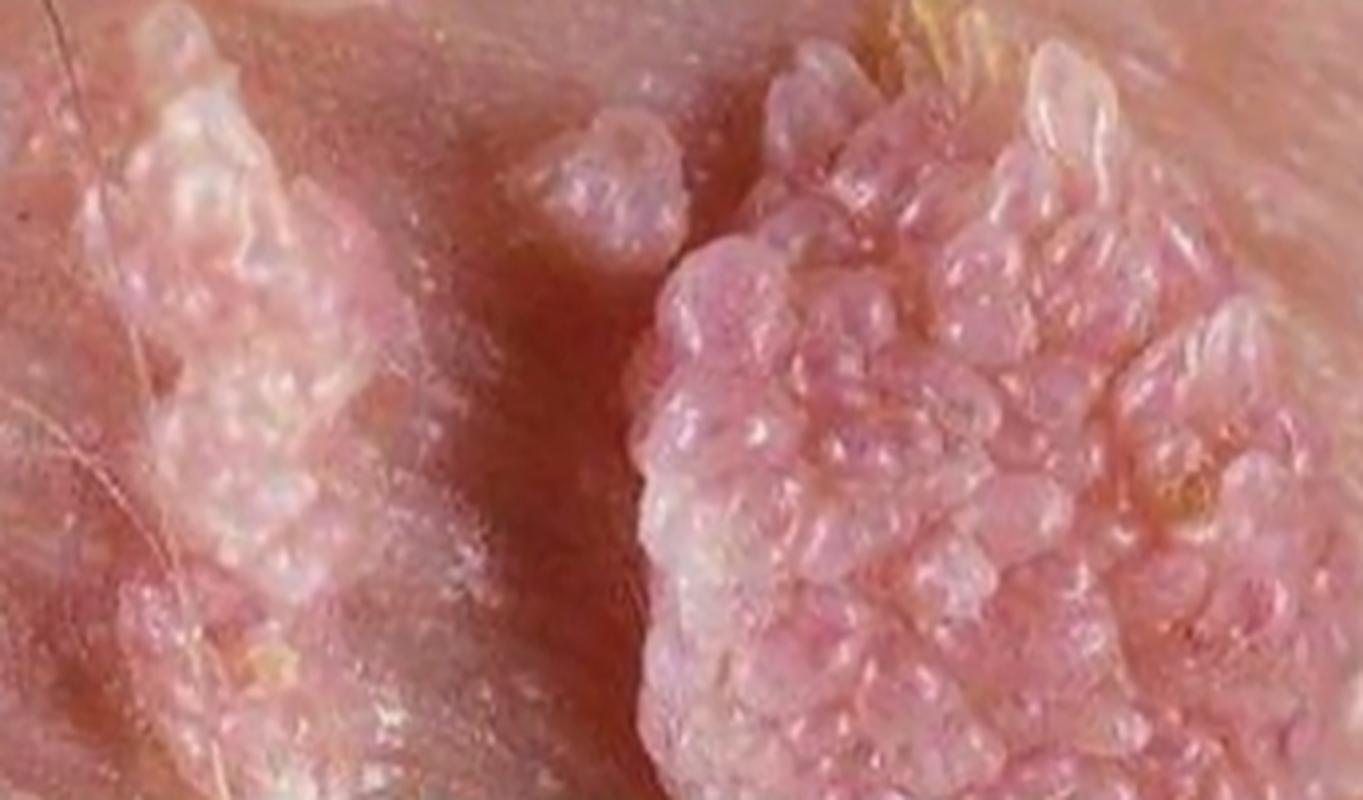 做hpv检查后几天不能同房