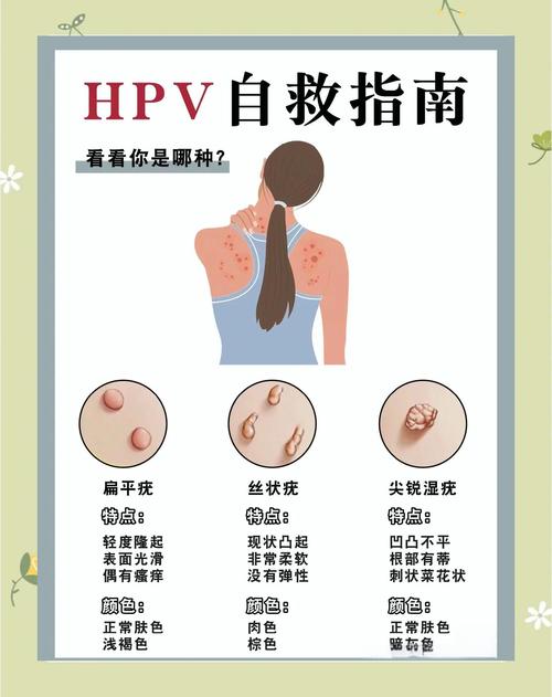 HPV感染能治好吗