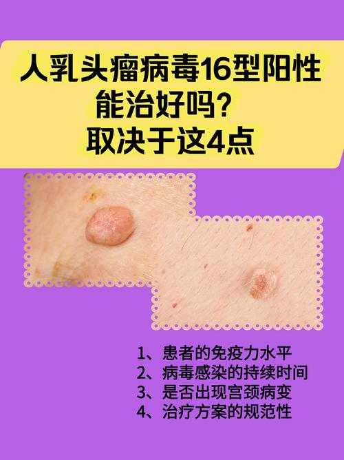 HPV高危感染难治愈吗?