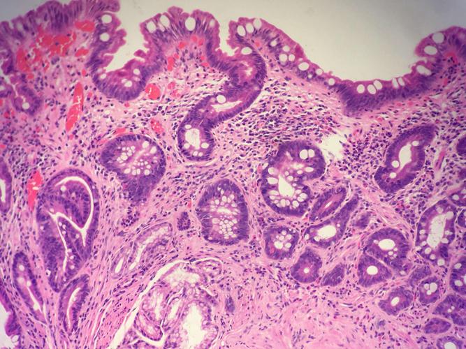 病理hp是什么意思